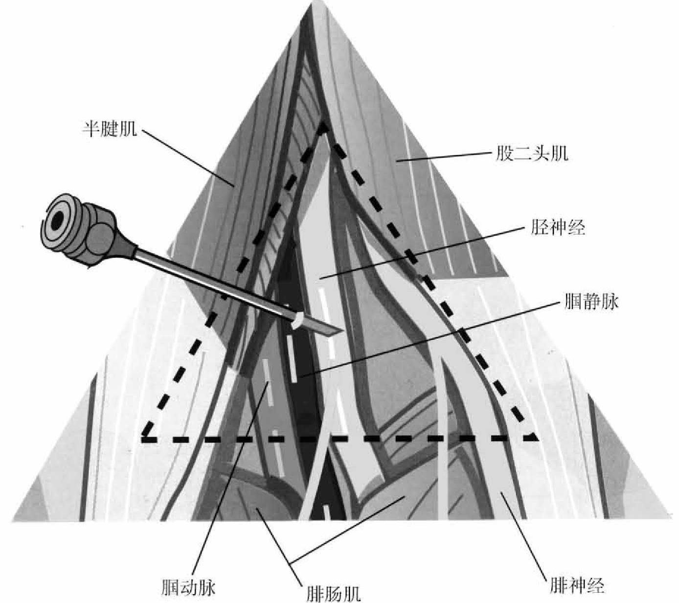 第五節(jié) 脛神經(jīng)射頻鎮(zhèn)痛治療